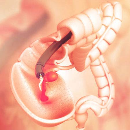 colonoscopy in Chennai