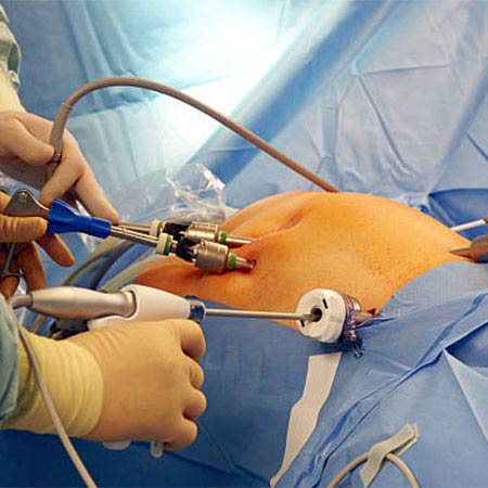 laparoscopy surgery in Chennai