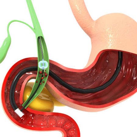 biliary surgery in Chennai