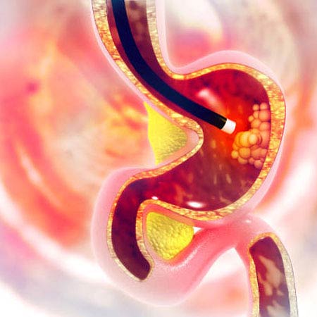endoscopy in Chennai