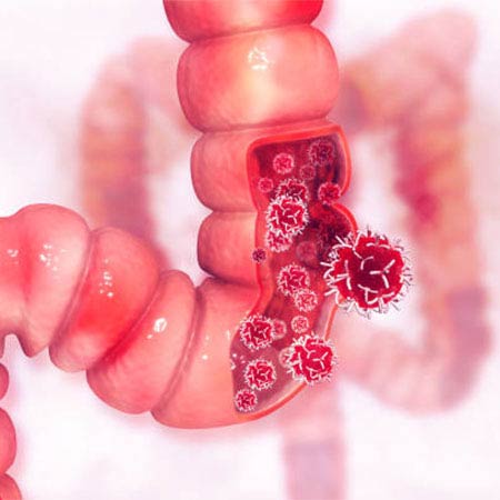 gastrointestinal cancer treatment in Chennai